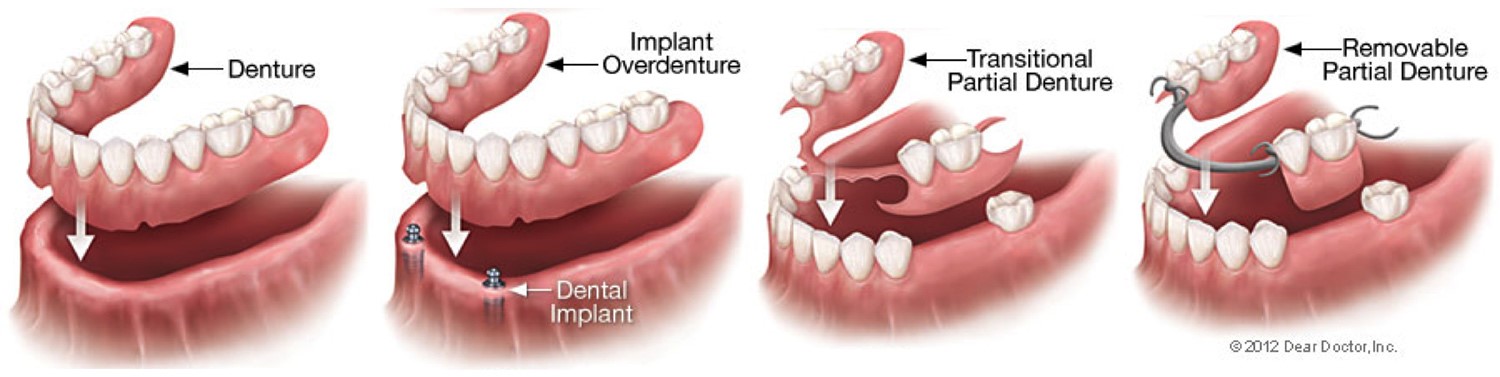 Occlusion In Complete Dentures Midway TX 75852